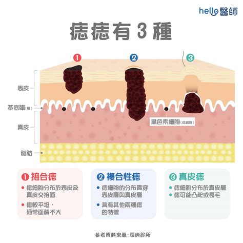 痣 原因